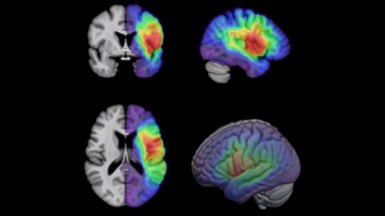 Composite samples of the MRI images that AStrID, the Acute Stroke Imaging Database, will draw on to advance research that promises to optimize stroke rehabilitation.