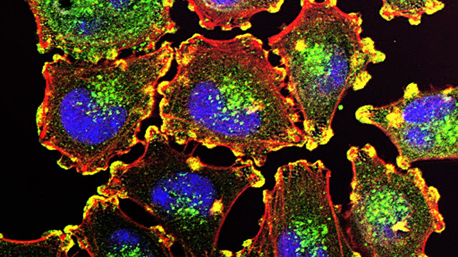 Microscope image of melanoma cells. Courtesy of Julio C. Valencia, NCI Center for Cancer Research