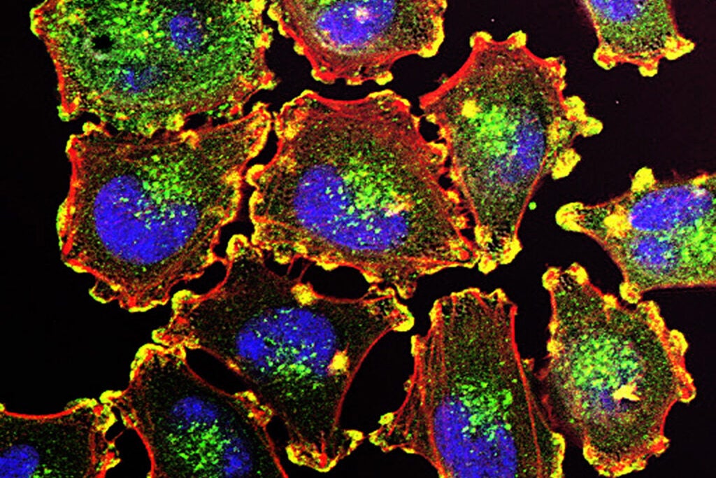 Microscope image of metastatic melanoma cells. Photo courtesy of Julio C. Valencia, NCI Center for Cancer Research